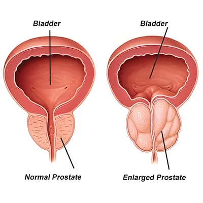 enlarged-prostate